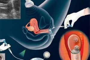 提前一天进行胚胎移植会对胚胎的着床产生影响吗?