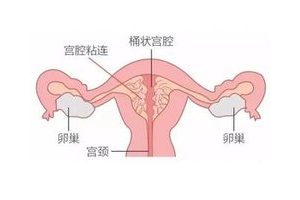 试管婴儿胚胎移植后,如果感到胃部胀气该怎么办?