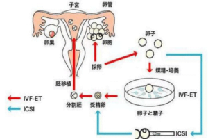 第三代试管婴儿(胚胎植入前遗传学检测PGT):重要事项详细解