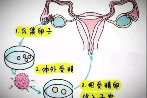 高龄女性进行试管婴儿时,这些关键注意事项务必要提前了解!