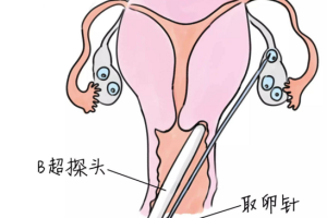 试管婴儿一次成功吗?成功率及其关键影响因素详解