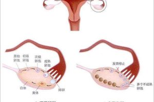 试管婴儿取精指南:全面流程与注意事项