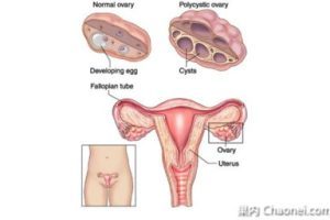 在选择试管婴儿技术时,应该考虑哪一代的技术比较合适?不要被“