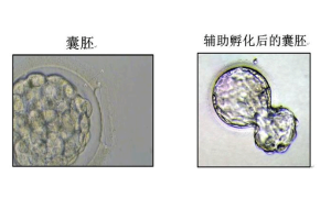 试管婴儿之前是否需要检查输卵管?答案在这里!