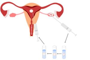 试管婴儿前期需要检查HPV吗?