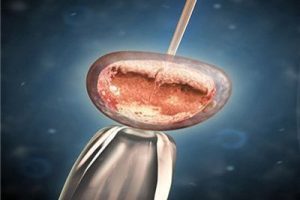 我的第三代试管婴儿旅程