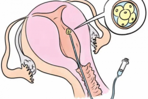 试管婴儿是选择长方案还是拮抗剂方案?